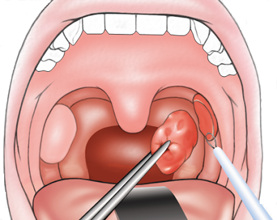 Tonsillectomy & Adenoidectomy image