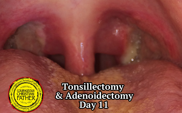 Tonsillectomy Recovery & Adenoidectomy Recovery - Day 11