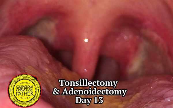 Tonsillectomy Recovery & Adenoidectomy Recovery - Day 13