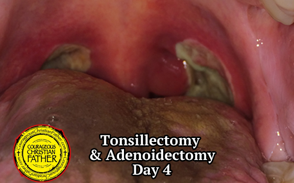 Tonsillectomy Recovery & Adenoidectomy Recovery - Day 4