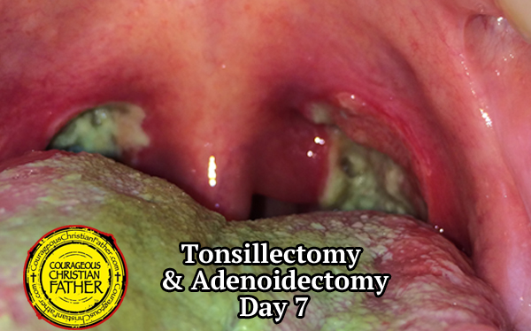 Tonsillectomy Recovery & Adenoidectomy Recovery - Day 7