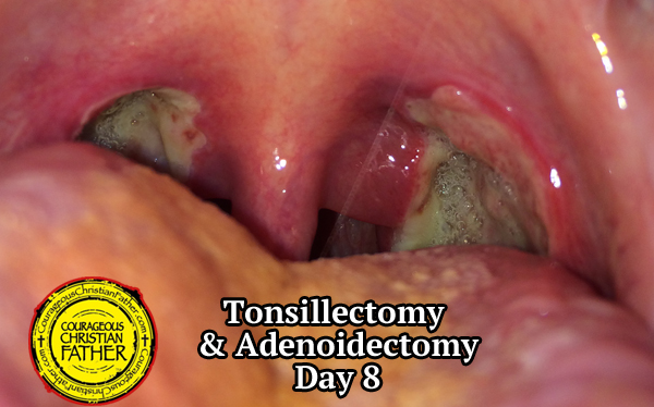 Tonsillectomy Recovery & Adenoidectomy Recovery - Day 8