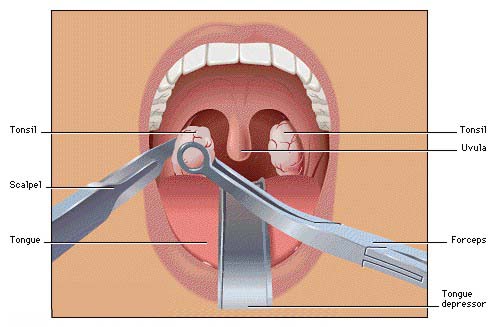 Tonsillectomy & Adenoidectomy Surgery