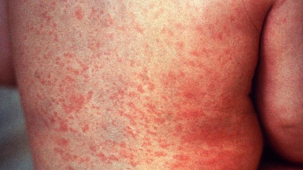Confirmed Measles in East Tennessee - this was once one of the vaccines that a child gets to help prevent this disease. But, today, many parents are opting out of these vaccines. #measles